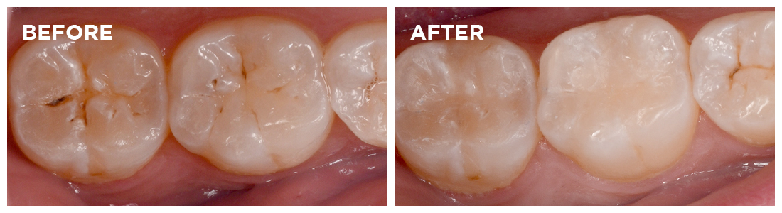 fissure-sealants-drummoyne-dental-practice